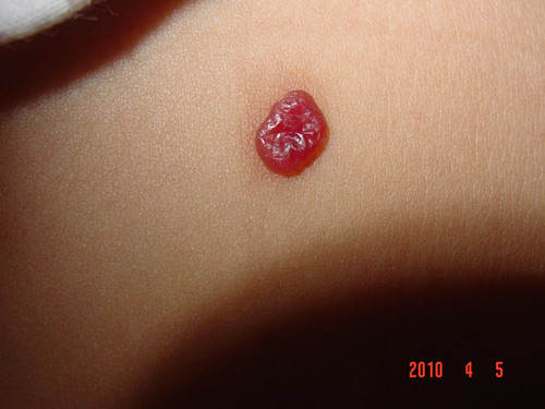 葡萄瘤 皮肤图片