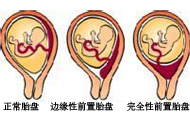 前置胎盘分哪几种？有什么症状？